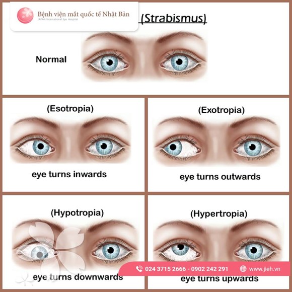 Bệnh lác mắt – Triệu chứng, nguyên nhân và điều trị | Bệnh viện mắt